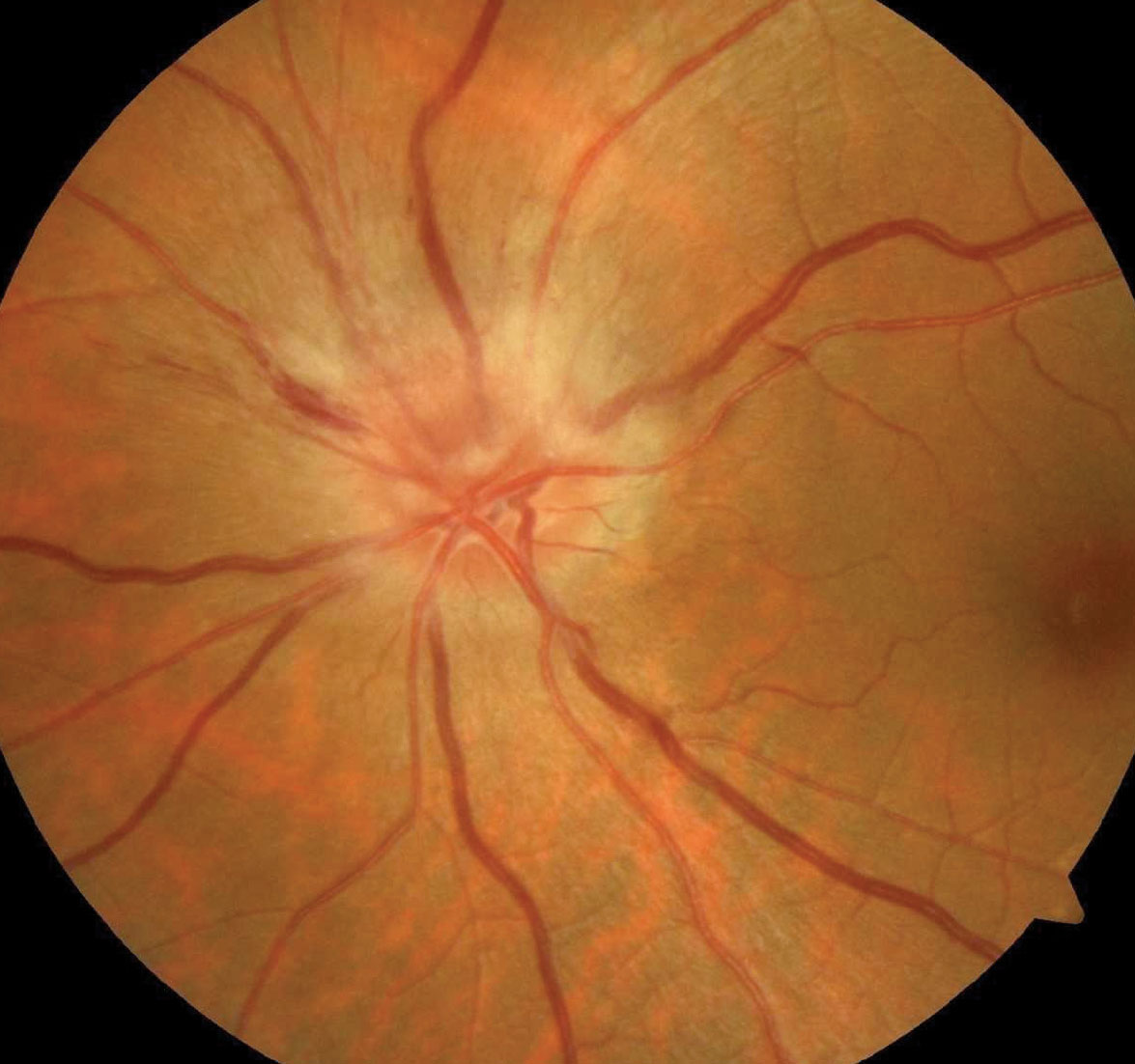 Diabetes, greater initial VF damage and severe sleep apnea were found to be risk factors for fellow eye involvement in NAION.