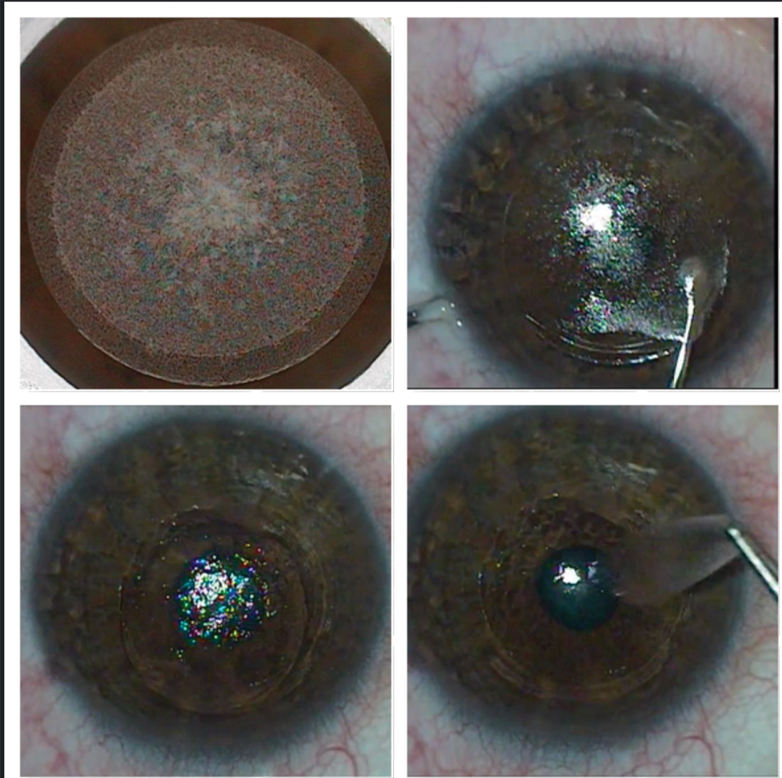 Study suggests using a thinner cap to achieve a thicker residual stromal bed and a lesser decrease in corneal biomechanical strength in the SMILE procedure.