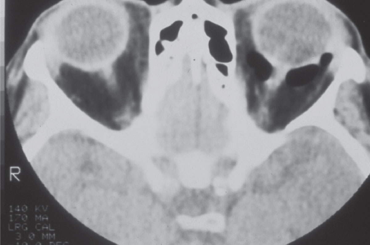 Fig. 1. A CT image of the orbits in a patient with a left orbital floor fracture. Note the image void behind the left eye; this is air, and the retrobulbar orbit is contiguous with the maxillary sinus beneath due to the fracture.