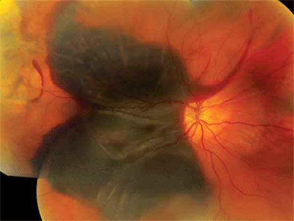 Close monitoring for signs of submacular hemorrhage may be warranted for AMD patients taking blood-thinning medication.