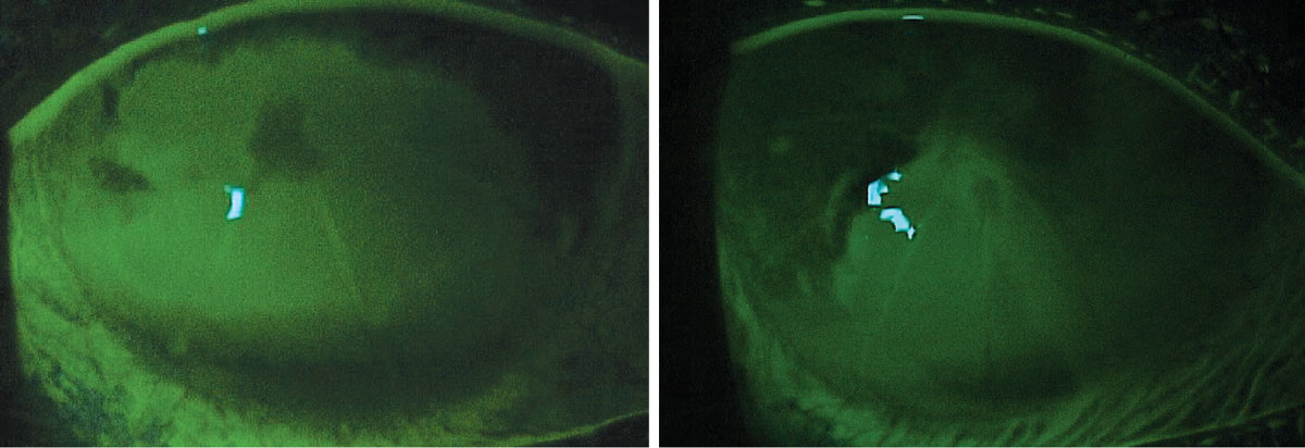 Fig. 3. Bilateral corneal injury from exposure to Simple Green household cleaner after instillation of sodium fluorescein dye. This patient previously had a radial keratotomy procedure.