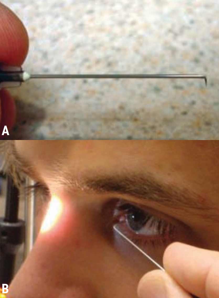 Fig. 2. (A) Properly bent needle to perform anterior stromal puncture in the treatment of RCE. (B) ASP being performed tangential to the corneal plane.