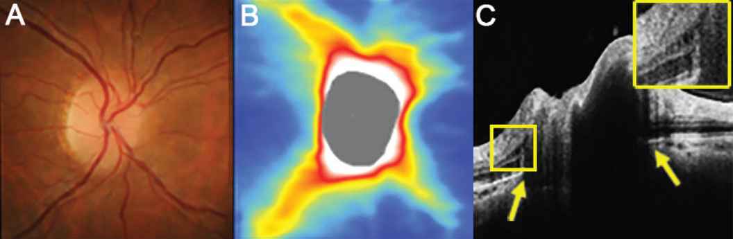 Patients at all stages of papilledema had significantly reduced GC-IPL compared with controls, with the thinnest GC-IPL found in the atrophic group. In these images, (A) the right disc has minimal visible cup with some subtle blurring of the superonasal disc margin, (B) OCT thickness heat map shows thick superior and inferior RNFL and (C) a high-density OCT line scan shows anterior protrusion of Bruch’s membrane at its opening (yellow arrows) and intraretinal cystic spaces temporal to the disc margin (inset).