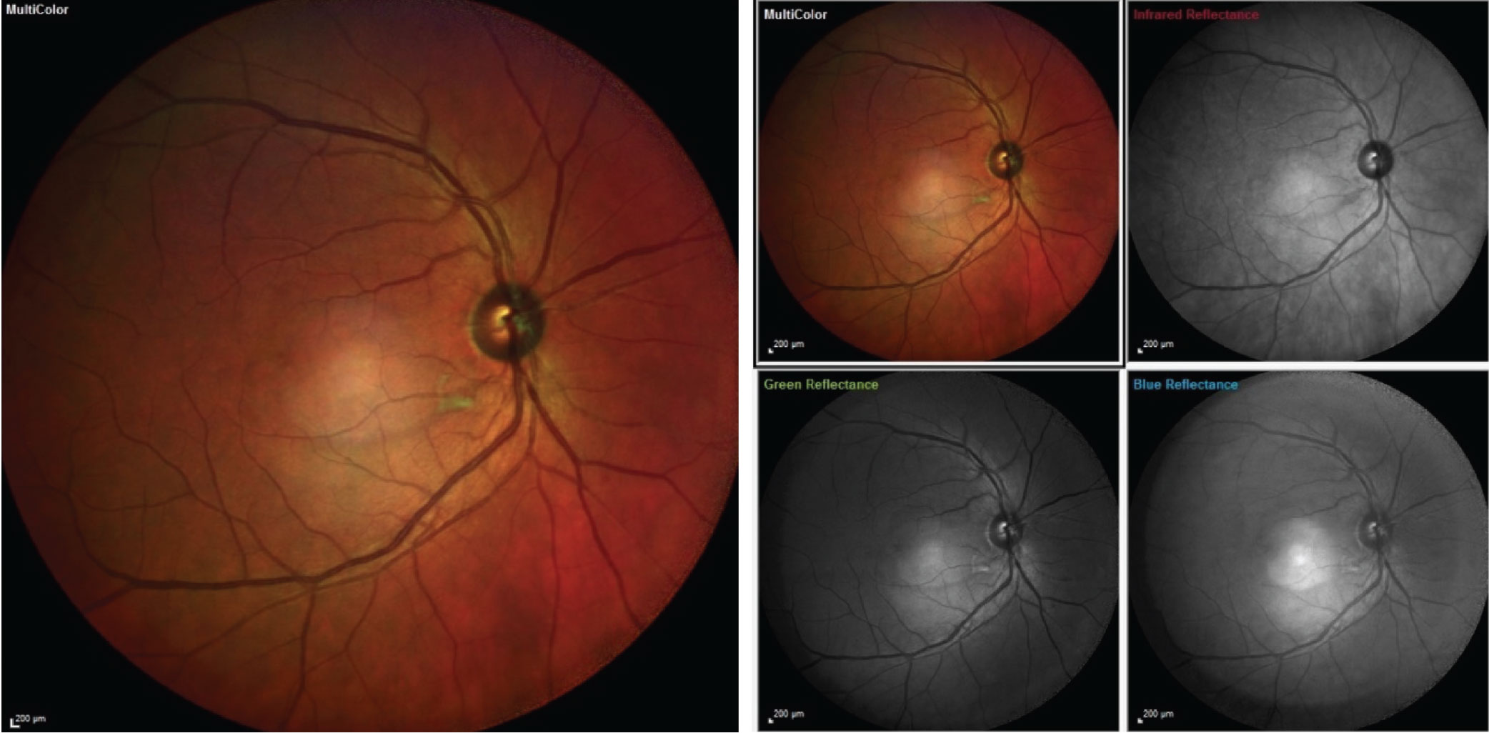 The patient’s initial visit in 2018 showed only one isolated cotton wool spot along the inferior arcade, which is consistent with the iris neovascularization, ocular ischemia and complaints of visual disturbances.