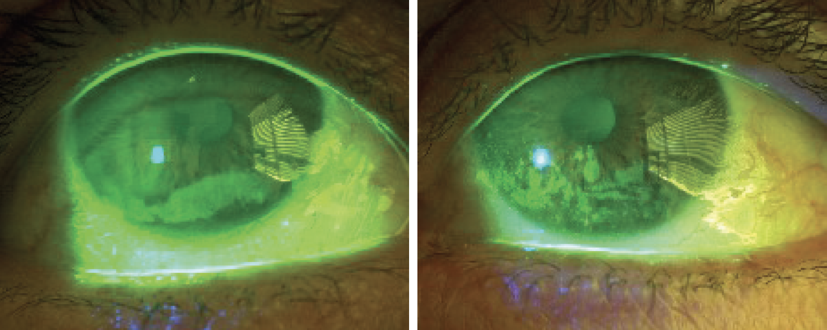 Fig. 1. OD persistent inferior corneal epithelial defect, OS persistent confluent inferior and central SPK.