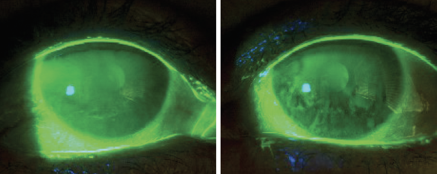 Fig. 2. At left, OD improvement of epithelial defect after amniotic membrane. At right, OS improvement of confluent SPK after amniotic membrane.