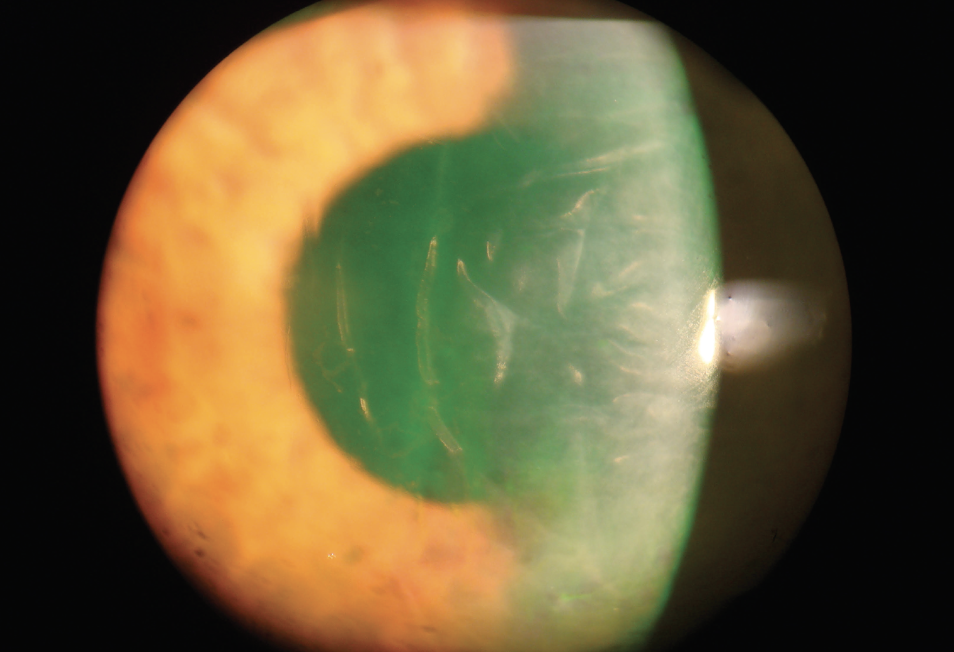 Corneal swelling and endothelial folds at a one-day cataract surgery post-op.