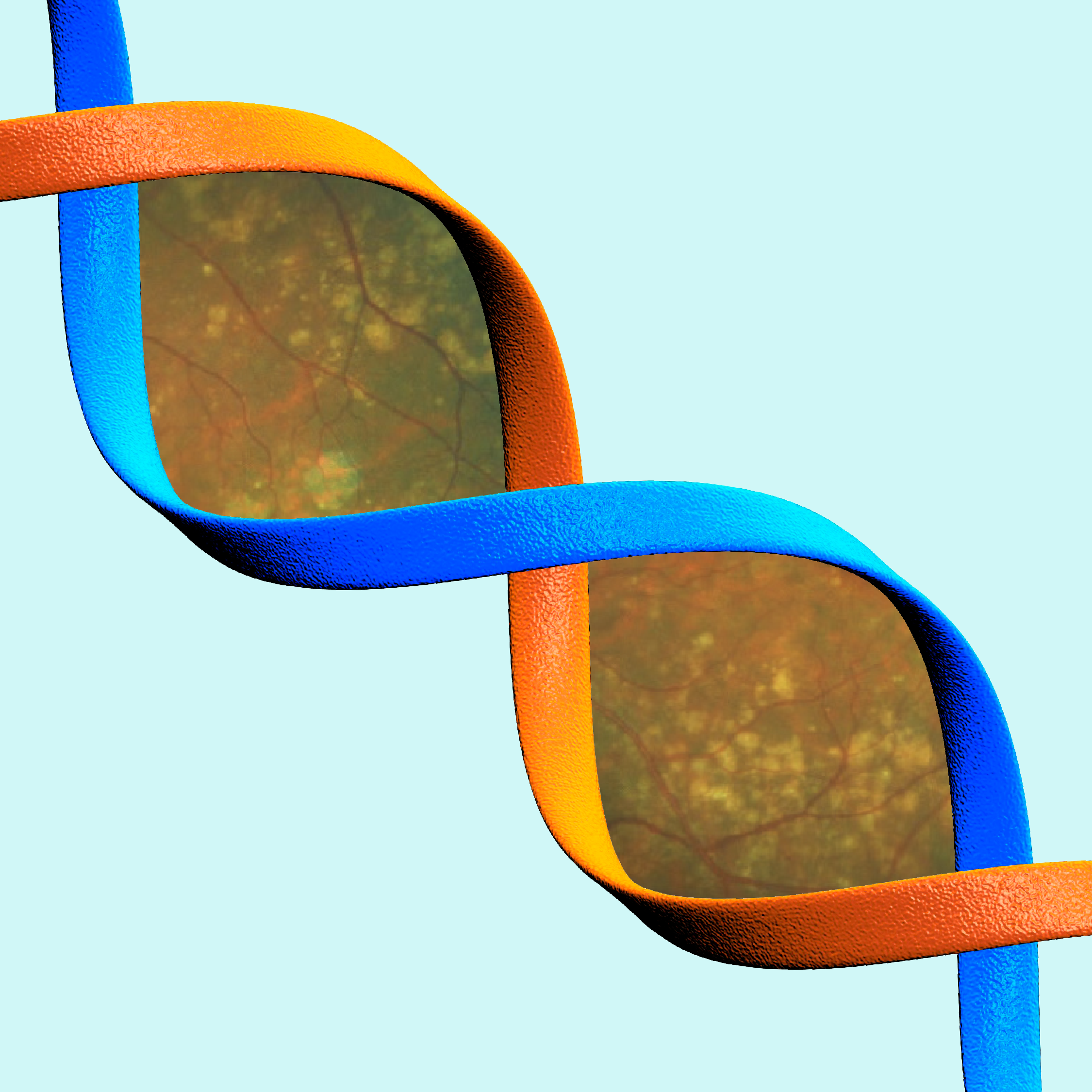 A recently developed composite risk score model appeared more effective at anticipating progression than the model with more than 30 genetic variants known to be related to prevalent AMD.
