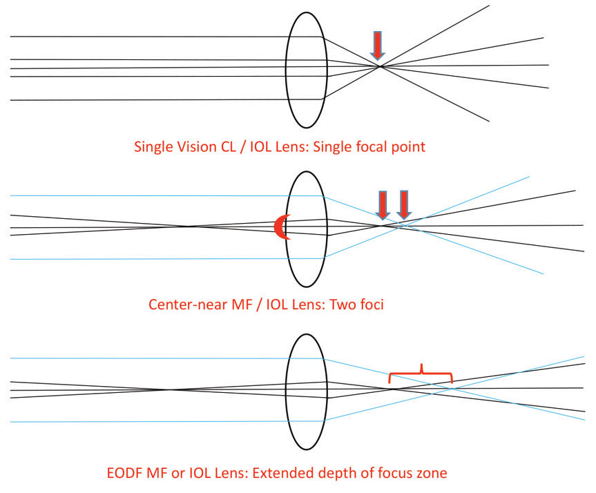 While no IOL achieves perfect vision or satisfaction in all visual environments, newer EDOF options have given many patients a greater range of acceptable outcomes.
