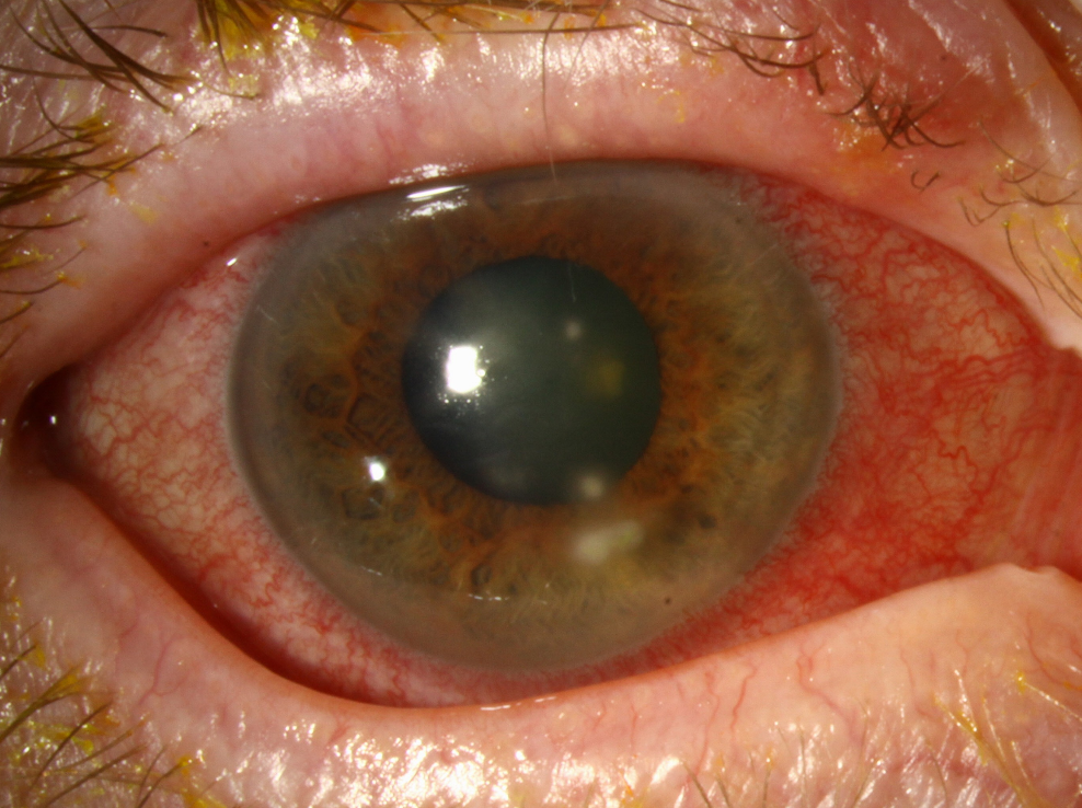 Complete corneal healing after using PACK-CXL was reported in the second month postoperatively in 90% of eyes.