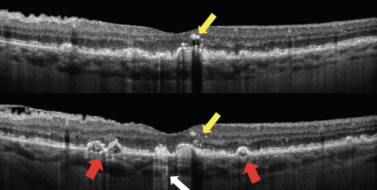The distribution of intraretinal hyperreflective foci—not just their presence—is the key driver associated with the risk of progression. The two OCT scans above show a patient with hyperreflective foci (yellow arrows); drusen of irregular, non-uniform internal reflectivity (red arrows); and hyperreflective columns (white arrow).