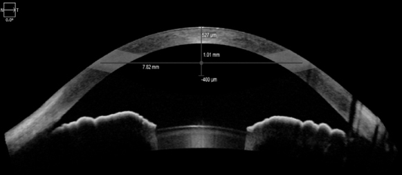 The cornea—a hormone-responsive tissue—is directly impacted by sex hormone changes in the body, shown in this literature review by the altered corneal features observed in women during menarche, pregnancy and menopause.