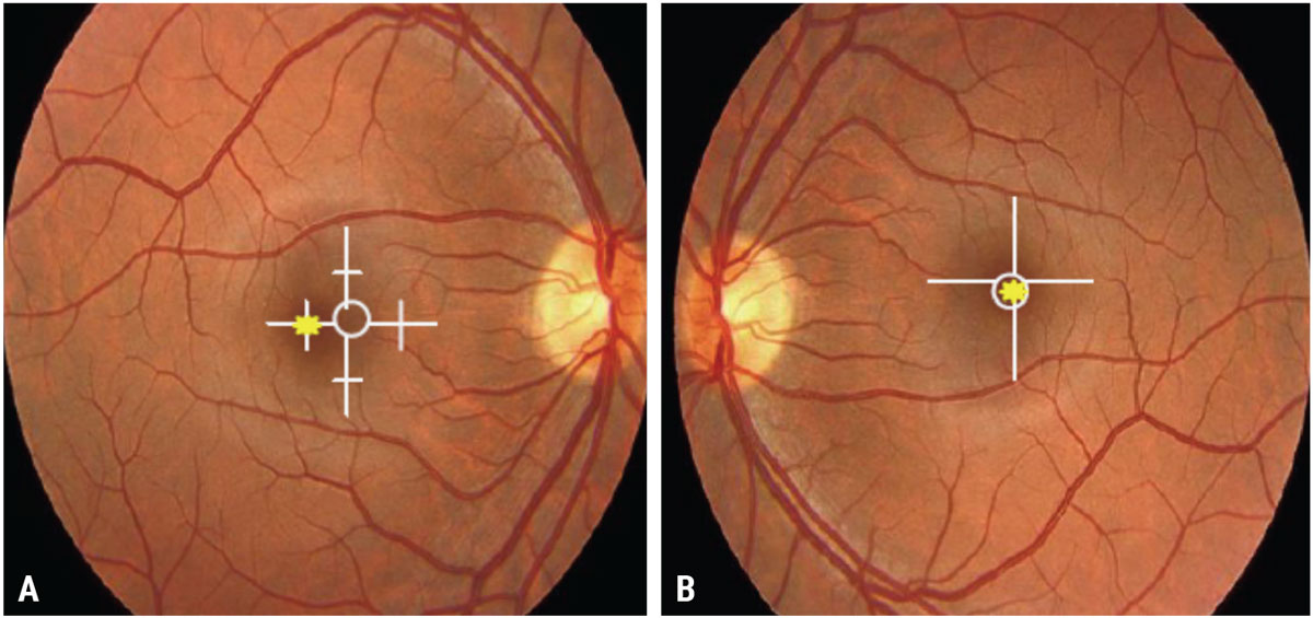 Fig. 2. (A) Approximately one prism diopter nasal EF in the right eye; (B) Central fixation (no EF) in the left eye.