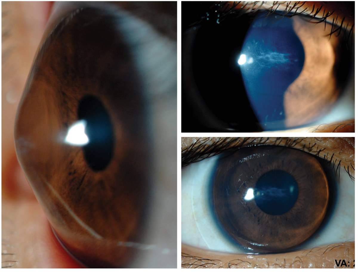 Figs. 1 and 2. A custom soft lens may allow for a stable fit and significant improvement in patient comfort for an individual who has failed with other options.