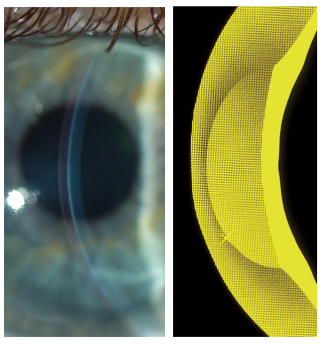 Fig. 8. The maximum irregular astigmatism correcting ability is reached at a center thickness of 0.5mm, which is over the central optic zone and does not extend over the carrier/haptic portion of the lens. 