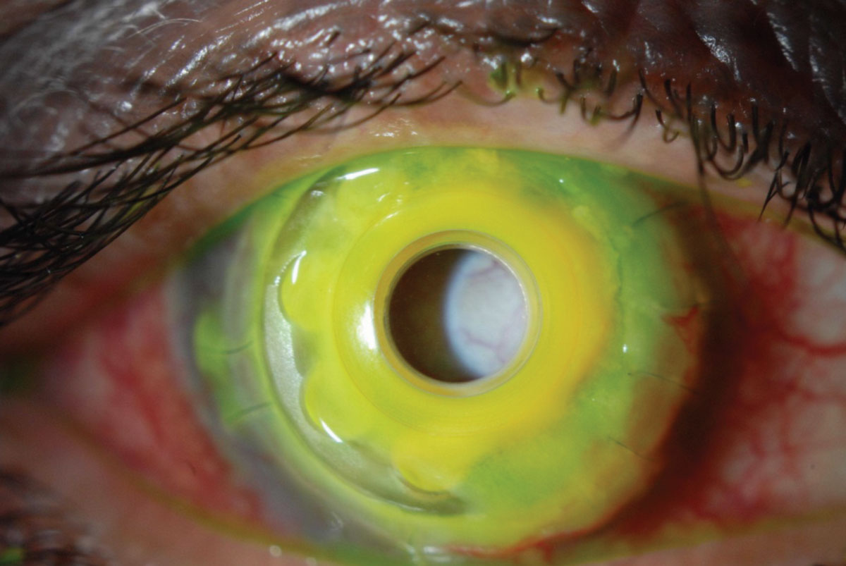 Fig. 2. A KPro with melting carrier cornea and fungal infiltrate around the stalk of the prosthesis. Note, this is an older version of the KPro with a PMMA back plate.