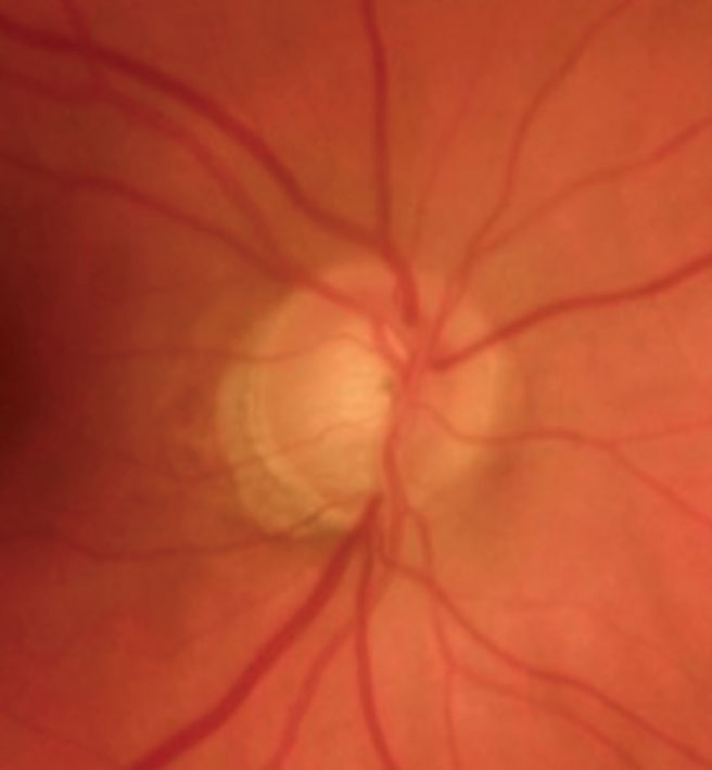 Fig. 1. The patient’s right eye in 2009. Note the thinning of the inferotemporal neuroretinal rim, calling into question the likelihood of glaucoma.