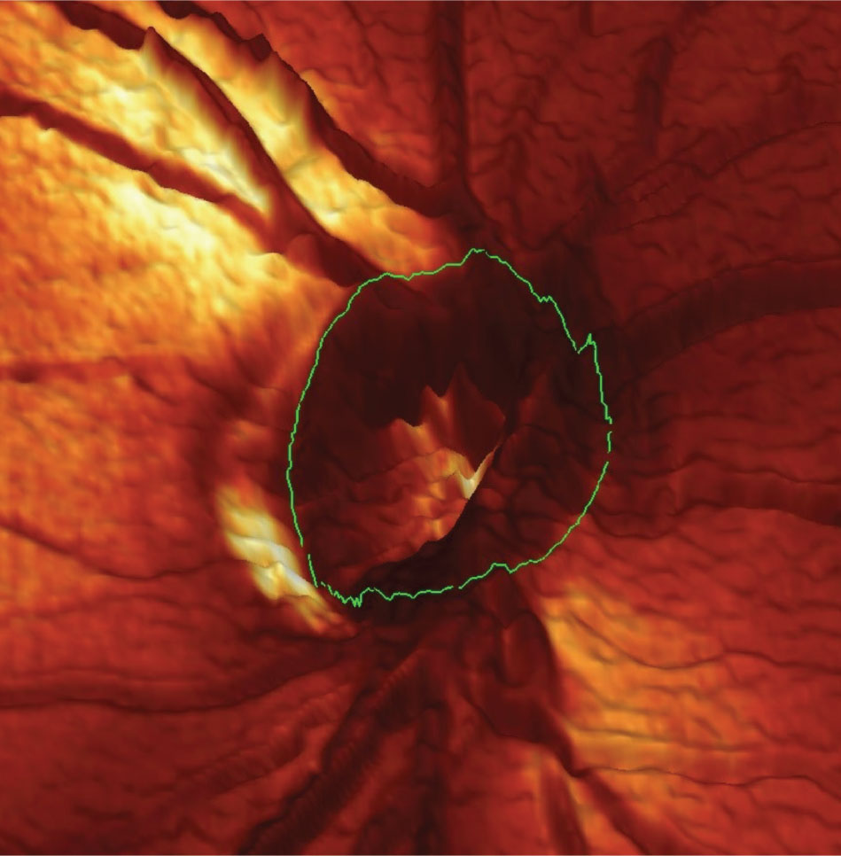 Fig. 2. This is an HRT 3 tomogram of the right optic nerve taken in 2009. Note the significant thinning and notching of the neuroretinal rim at the seven o’clock position. Moorsfield’s classification of this optic nerve at that time demonstrated a high likelihood of this sector being affected by disease rather than a statistical anomaly.