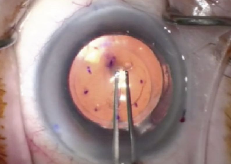 Descemet stripping only allows a person’s own endothelial cells to redistribute, skipping the need for a cornea transplant.