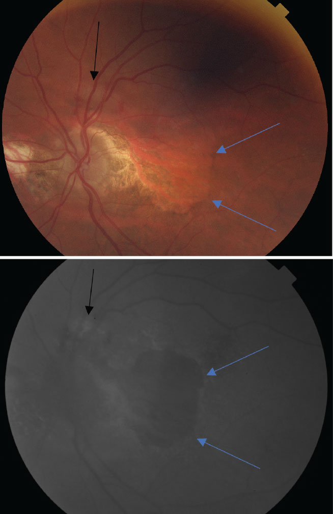 At top, a color photo of advanced AMD with extensive, central geographic atrophy (blue arrows) and a peripheral choroidal neovascular membrane located superiorly to the optic nerve (black arrow). At bottom, an FAF photo that shows an extensive amount of central hypofluorescence due to RPE loss and a small area of hyperfluorescence superior to the optic nerve caused by increased metabolic activity from the neovascular membrane.