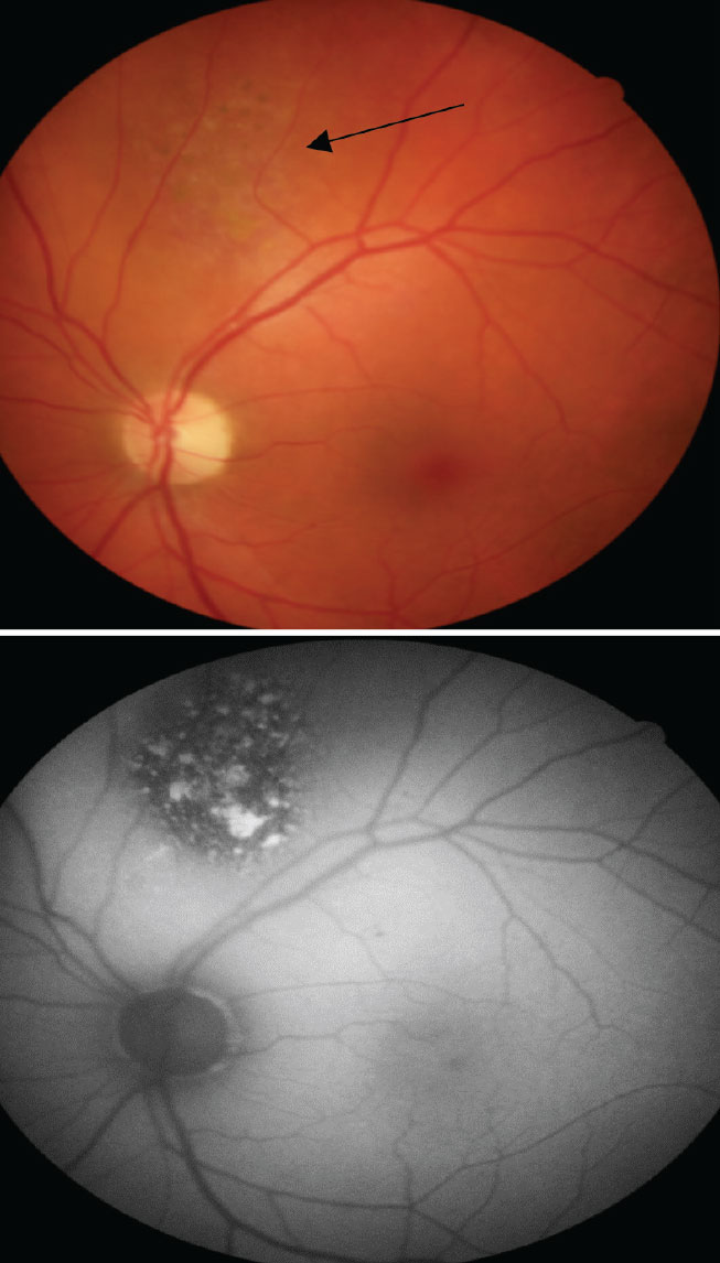 The top color photo reveals a faint, elevated and non-pigmented choroidal lesion (black arrow) that has overlying pigment changes due to RPE changes. On the bottom, the FAF helps to showcase the level of increased metabolic activity with multiple focal areas of hyperfluorescence from an accumulation of lipofuscin and hypofluorescence from RPE atrophy.