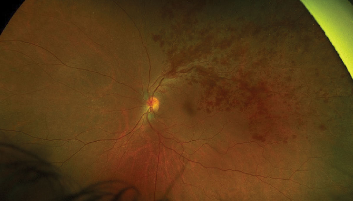 Fig. 6. Optos photo of a large branch retinal vein occlusion.