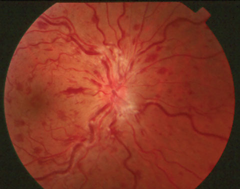 Retinal vascular occlusion has a multifactorial pathogenesis, but it may share similarities with COVID-19 effects, such as increased thrombosis and hypoxia.