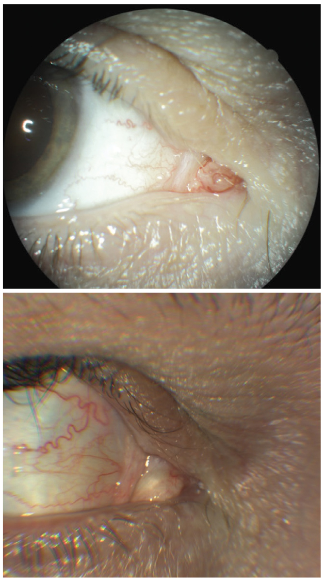 At top, mass in the caruncle right eye. Lesion was biopsied with histologic report of squamous papilloma. At bottom, 18 months post-op. Note the scar tissue.