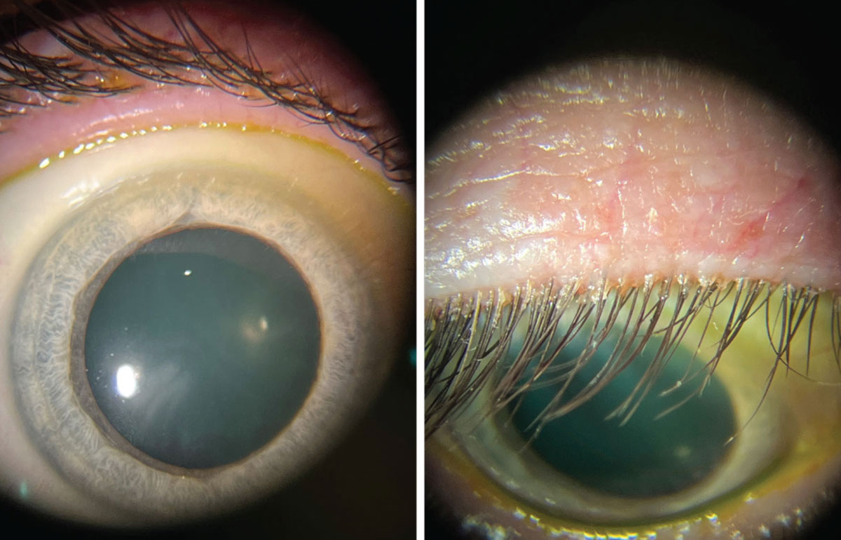 These photos show the same patient during a slit lamp exam. Left: Patient looking straight ahead with minimal identifiable blepharitis. Right: Patient looking down with obvious collarettes, indicating a Demodex infestation.