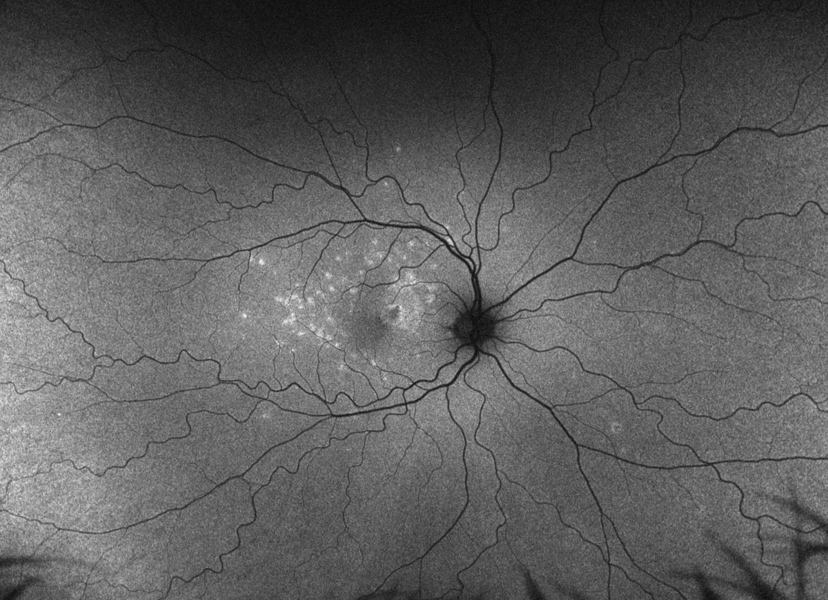 Fig. 2. Optos ultra-widefield fundus autofluorescence of the right eye.