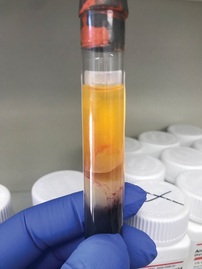Close up of a discarded tube seen in the previous image (second from the right) with obvious red blood cells present in the serum layer, creating a non-uniform pink-red color.
