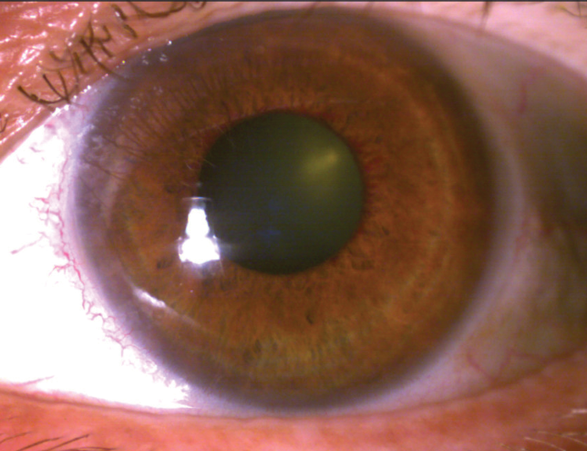 Peripupillary iris neovascularization.