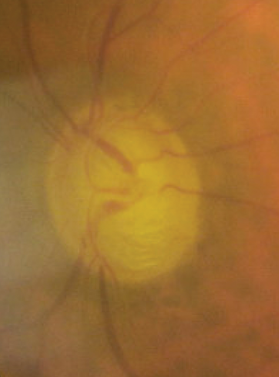 Advanced glaucomatous optic neuropathy due to NVG two months following initial presentation.