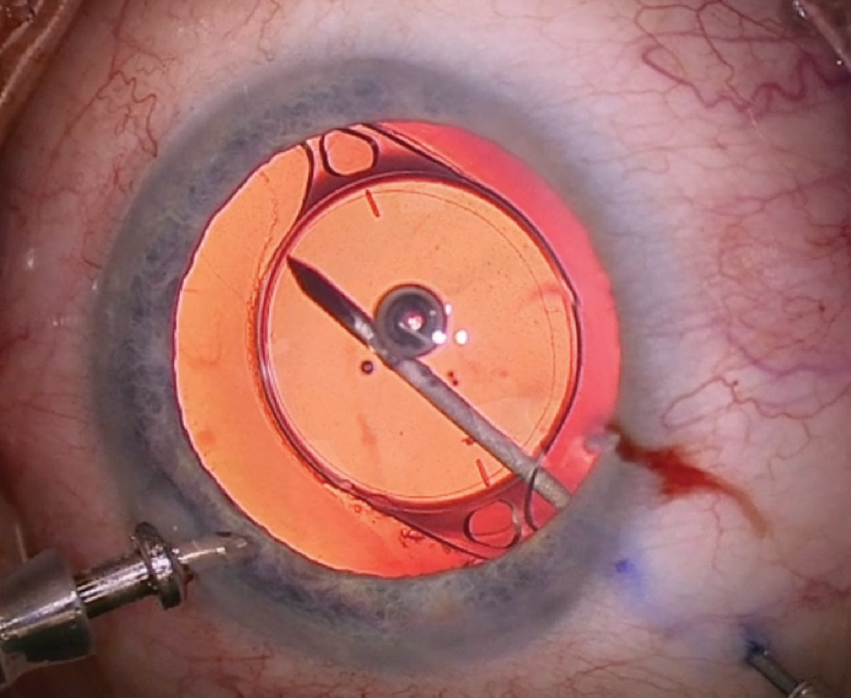 1-Step limited vitreous removal allows surgeons to remove a significant portion of the vitreous without viscoelastic or sutures.
