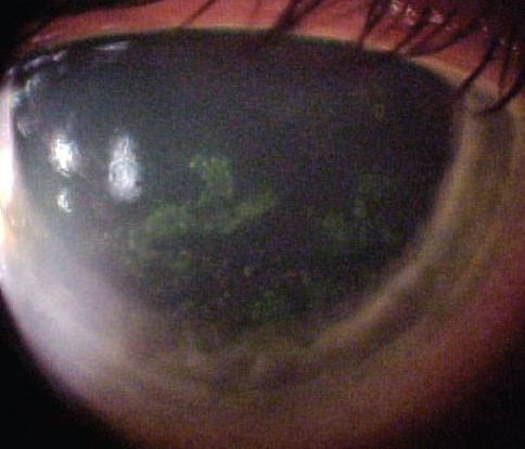 Slit lamp exam of the patient revealed these findings. What might be the origin?