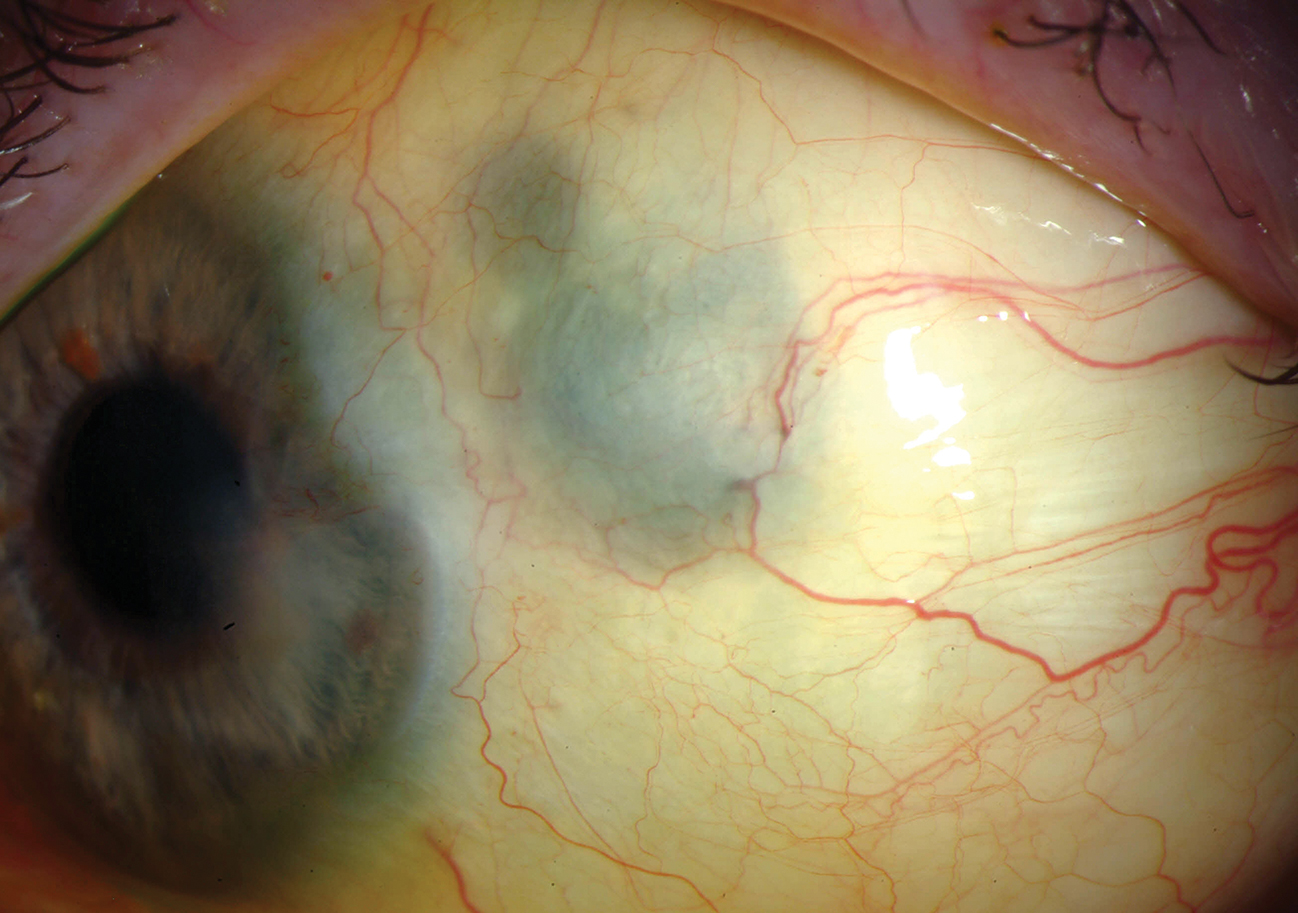 Scleral thinning
