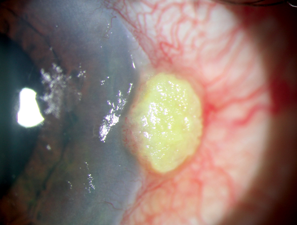 Ocular surface squamous neoplasia
