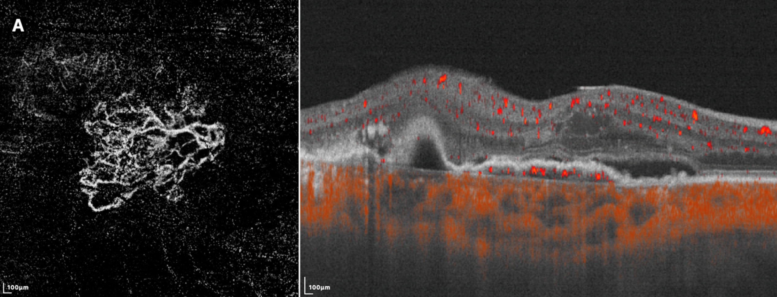 En face swept-source OCT- A (left) shows a loose pattern with characteristics such as anastomosis and loops. The corresponding B-scan SS-OCTA (right) shows subretinal fluid and rich flow signals under RPE. (From Gu X, et al. Diagnostics 2023, 13(14), 2458.