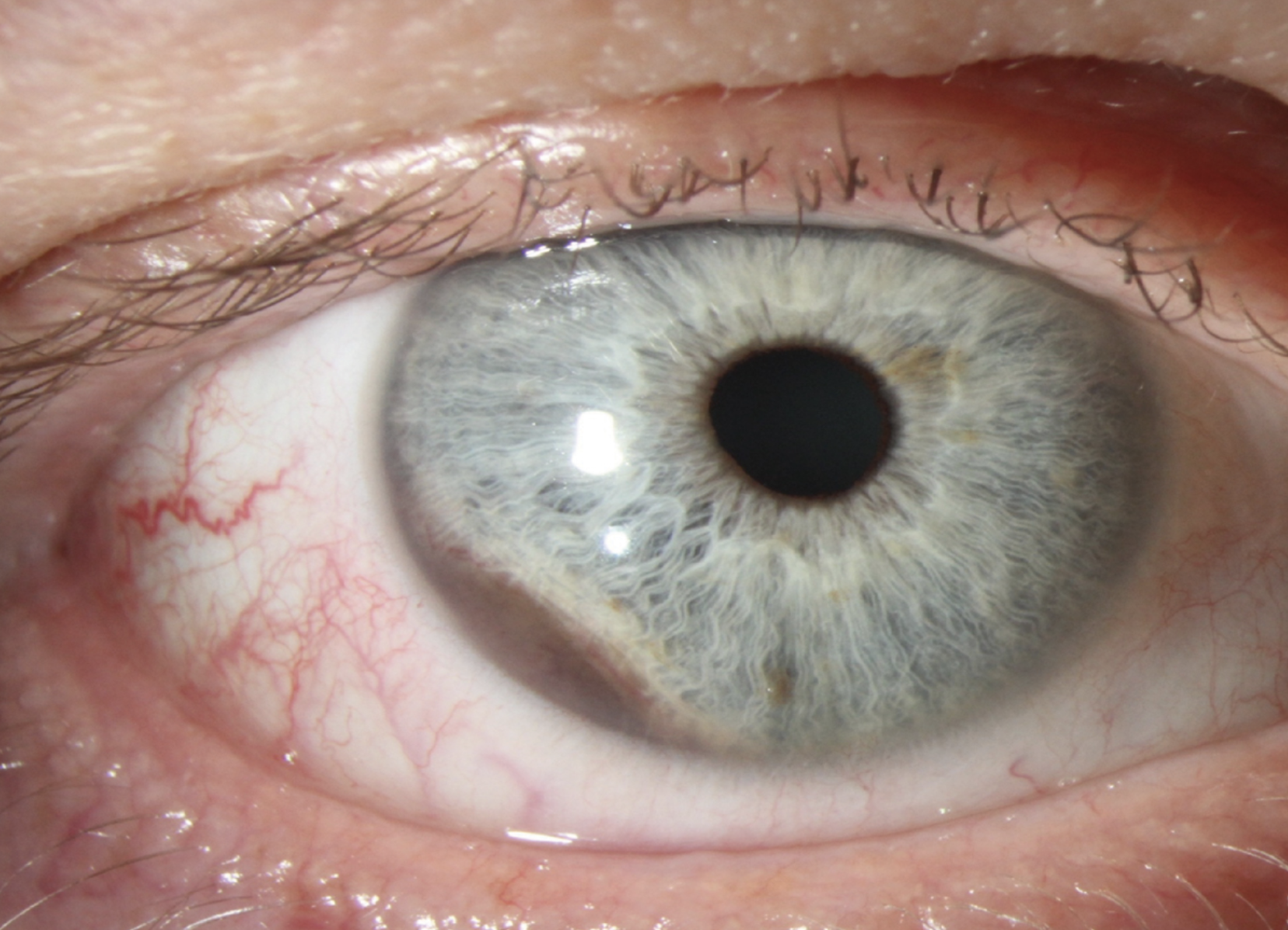 The anterior segment absorbs more ultraviolet radiation than the back of the eye, which may be why this study observed an increased risk of ciliary body/iris melanoma in those living in areas of high exposure.