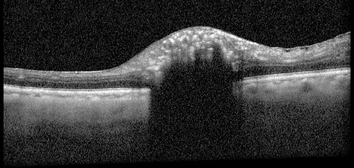 Fig. 3. Heidelberg Spectralis OCT of the left optic nerve head.