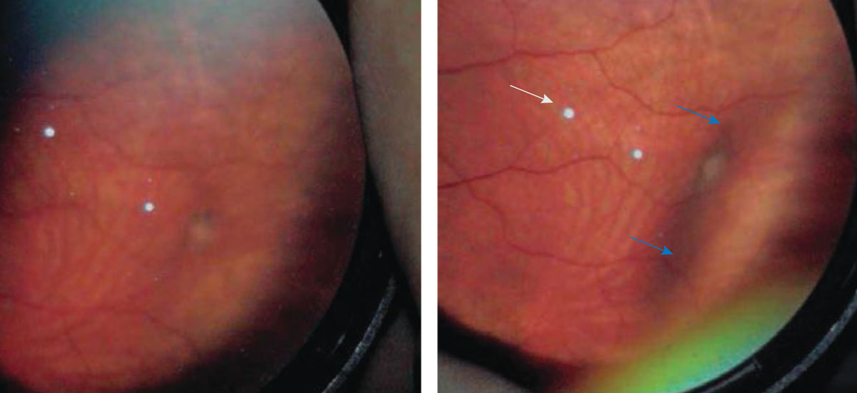 Fig. 4. This is a BIO view of a vitreal tuft. On the right is an indentation from applying a scleral depressor (marked by blue arrows) to improve the detail seen of the abnormality.3 The white dots (marked by white arrow) in both photos are lens artifact.