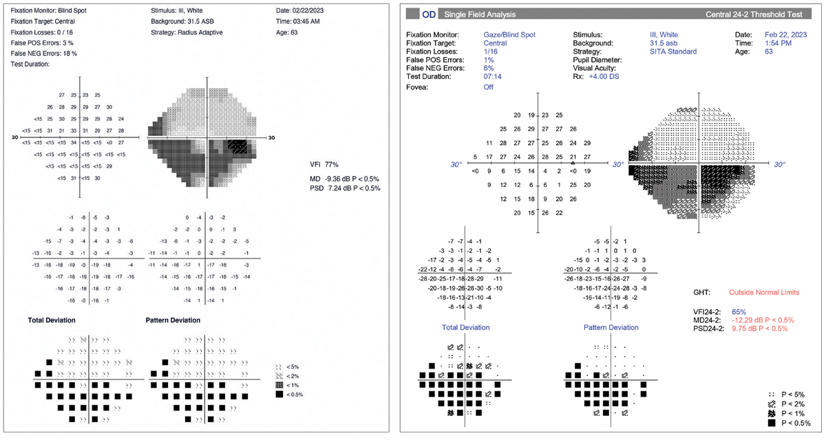 HMD (left) and HFA (right) examples of a glaucoma patient with a severe defect in the left eye. In this case, there is good general agreement between the two devices. However, there is a 3dB difference between the mean deviation values (HMD=-9.36; HFA=-12.29). Different testing strategies account likely account for this.
