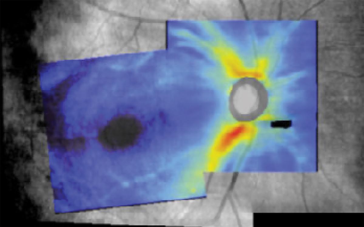 Combined RNFL and ganglion cell analysis map of the right eye demonstrating subtle superior temporal RNFL loss not extending to the optic disc. The area of missing data inferior nasal to the optic disc correlates to the posterior vitreous detachment.