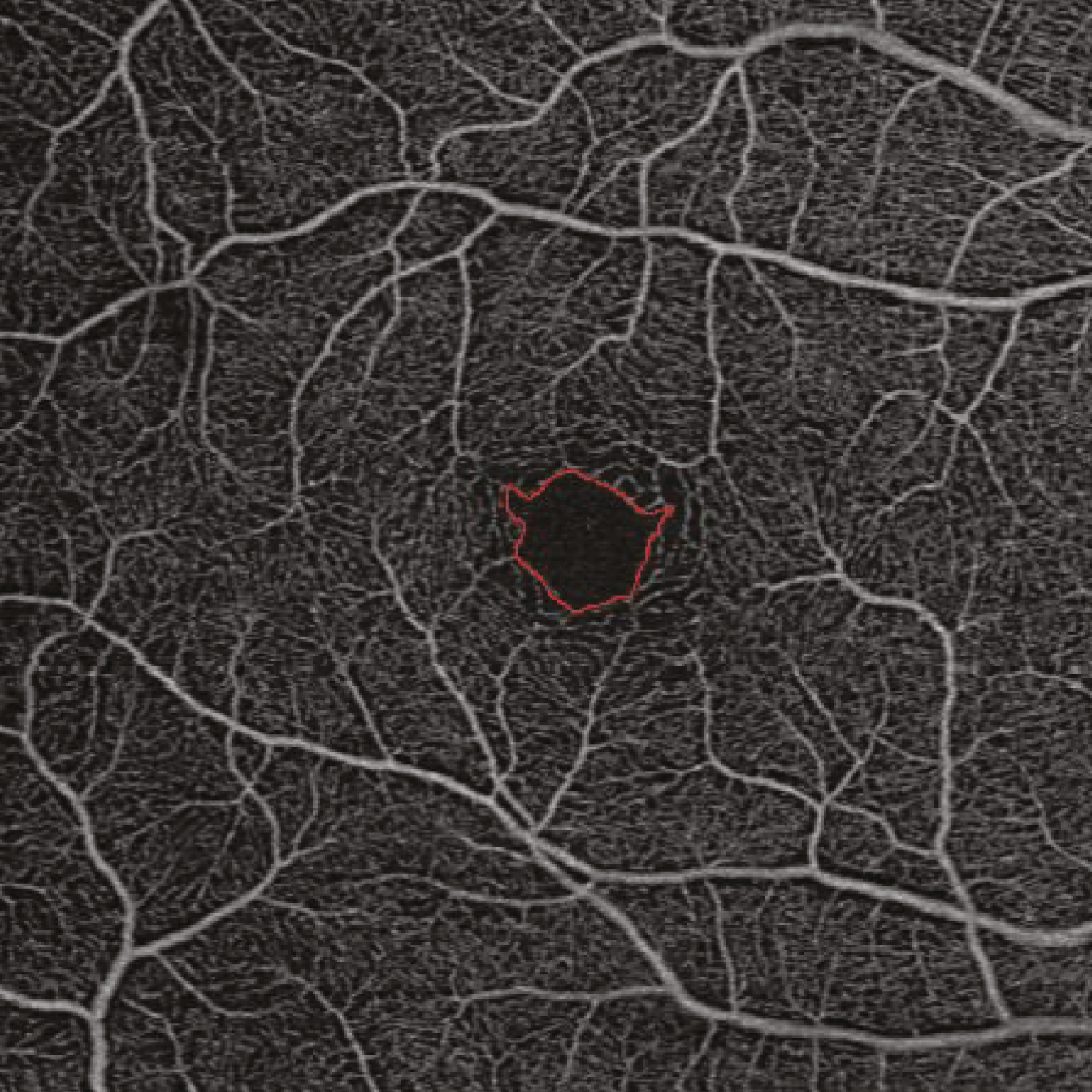 The added sensitivity provided by SS-OCT angiography may enable pre-clinical identification of diabetic eye disease, this study suggests.
