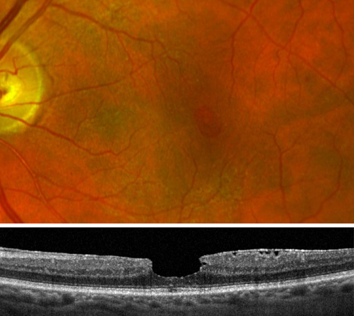The chatbot provided interpretations of ophthalmic images beyond information explicitly stated in the source database in some instances. One case presented to it and discussed in the journal article was macular pseudohole.