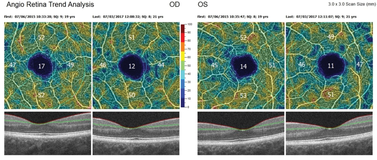 The retina acts as a projection of the central nervous system, providing a more convenient and accessible way to detect certain brain disorders. New research ties retinal vascular changes in diabetes (such as this case’s decline in vessel density over time) to cerebral small-vessel disease.