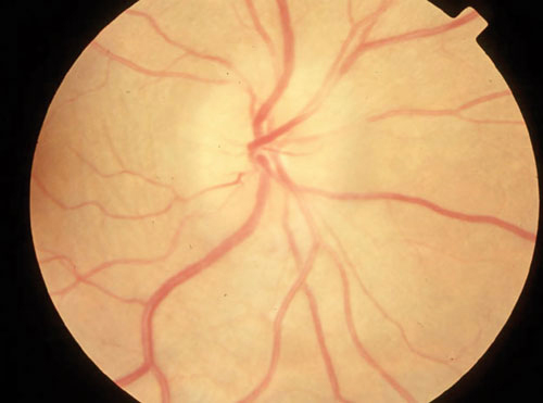 Optic neuritis (pictured) was the most common ocular manifestation of MS in the study. Internuclear ophthalmoplegia and nystagmus were also fairly common in this MS cohort, whereas other neuro-ophthalmic and uveitic symptoms were less so.