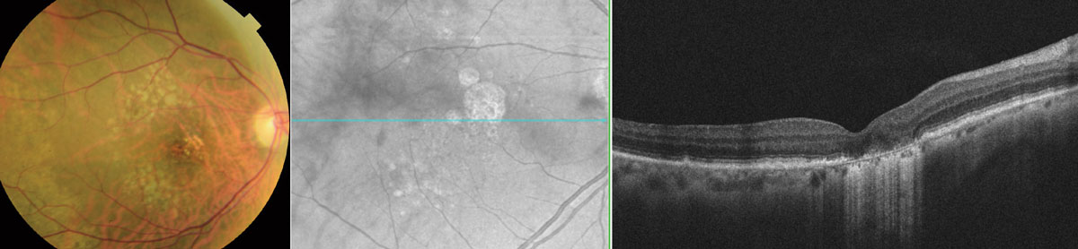 At a dose of 100mg, oral minocycline appeared to have no clinically meaningful treatment effect on GA in AMD among 37 Phase II trial participants. 