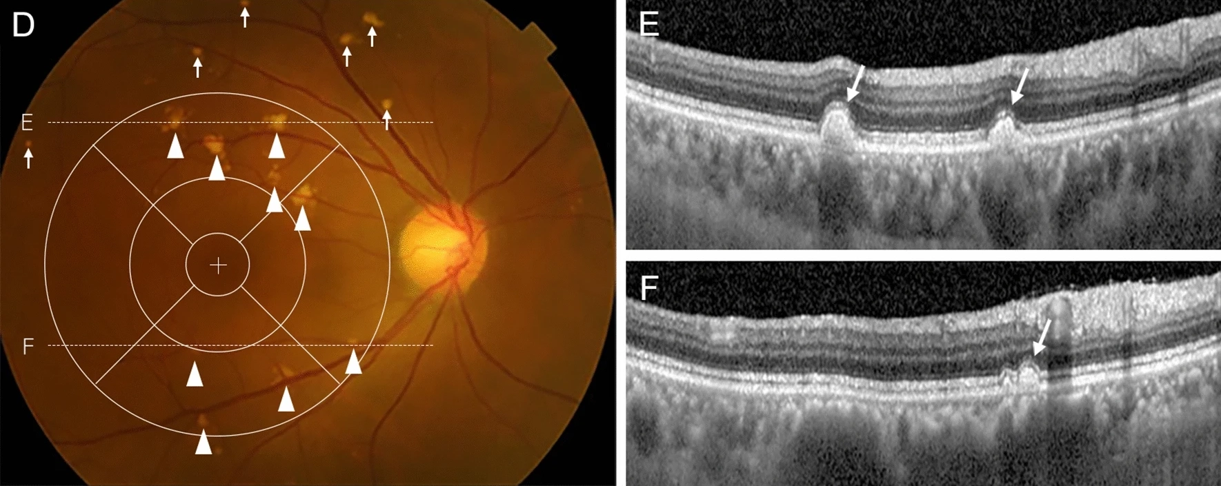 Eyes with pachydrusen had a risk profile for progression to advanced AMD that differed from that of AMD eyes without pachydrusen. In these images from the study, the fundus photo (D) shows pachydrusen in the macula (arrowheads) and extramacular areas (arrows) but no MNV or GA present, while two SD-OCT scans show corresponding sub-RPE deposits in scans done at the dashed white lines labeled E and F.
