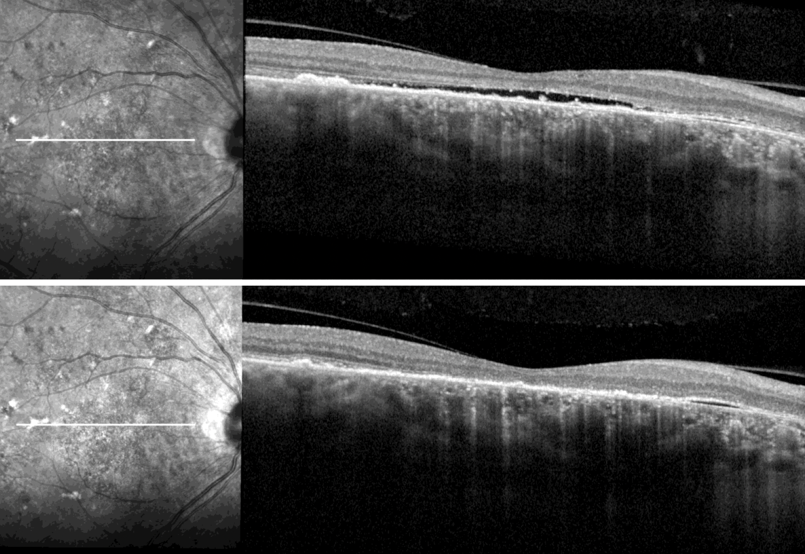 These photos from one subject in the study with chronic CSC show flat subfoveal subretinal fluid at baseline (top) and resolution following treatment with prednisolone eye drops for six weeks (bottom). Increased IOP could be one explanation for the observed reduction, the researchers suggest. 